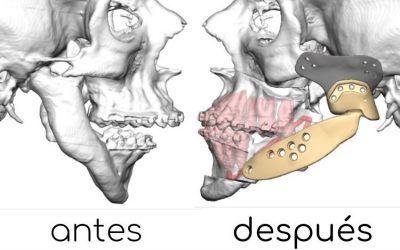 El Dr. Morey colabora en una reconstrucción facial compleja en el Hospital 12 de Octubre, de Madrid